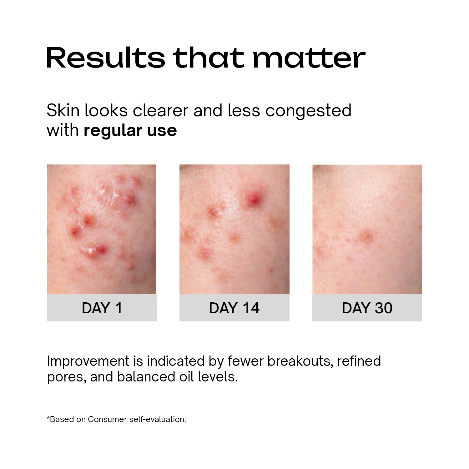 Salicylic Acid 2% Betaine 3% Serum - Image 5